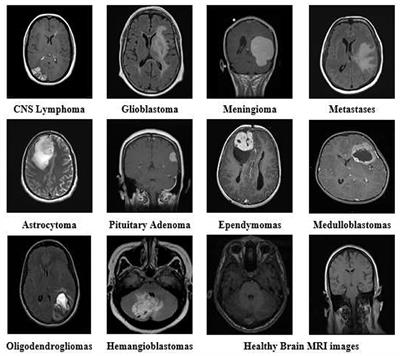 An enhanced pattern detection and segmentation of brain tumors in MRI images using deep learning technique